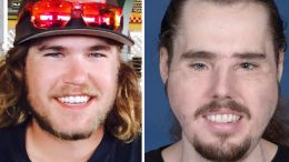 Full Face Transplant