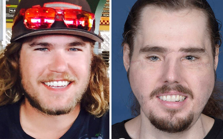 Full Face Transplant