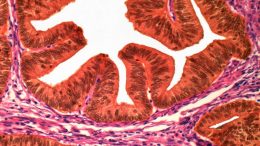 Uterine Cancer