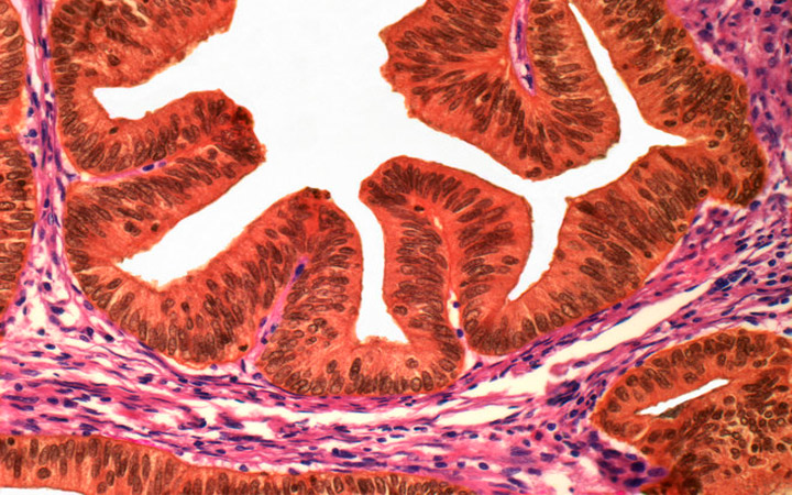 Uterine Cancer